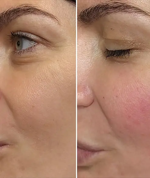 botox