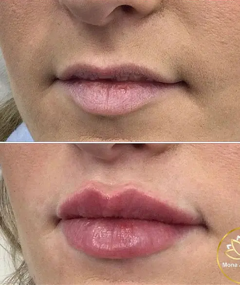 lips filler