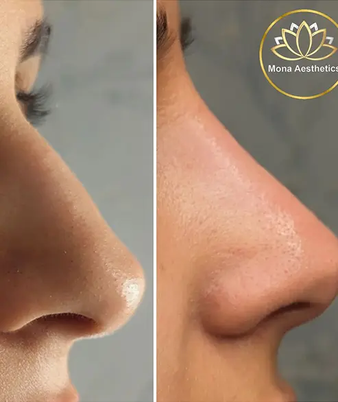 nose filler